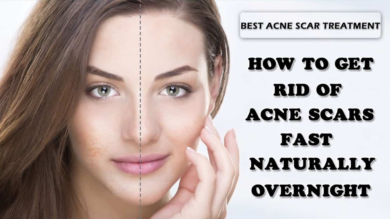 Top 5 Ways To Revome Acne Scars Rapidly - Shiftkiya.com