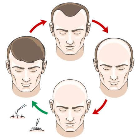 Hair Growth Cycle And Hair Loss