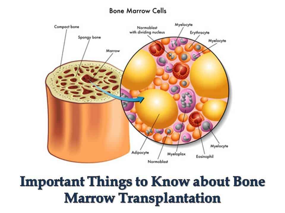 Important Things to Know about Bone Marrow Transplantation